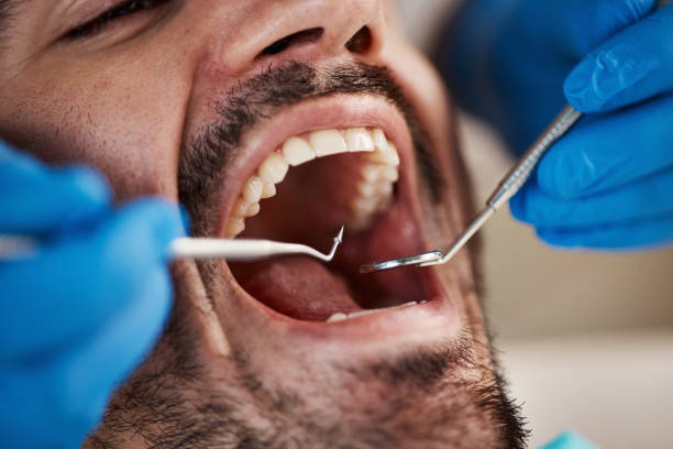 Best Knocked-Out Tooth (Avulsed Tooth) Treatment in Sparks, NV